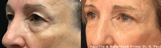Antes e depois  - AccuTite e Morpheus por Sean Paul 