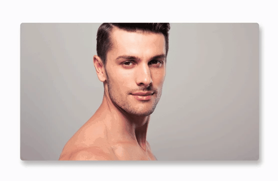 Cicatriz de Acne Skintec