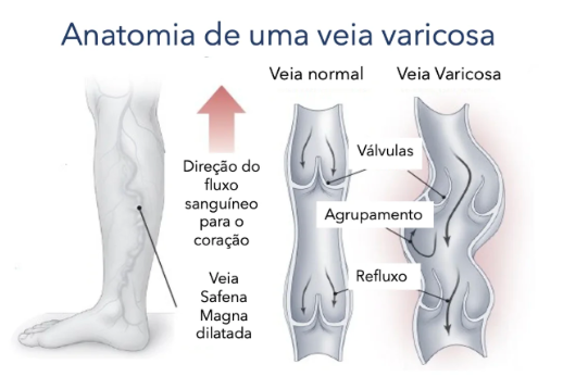 anatomia de uma veia varicosa - blog - SKINTEC