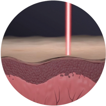 laser