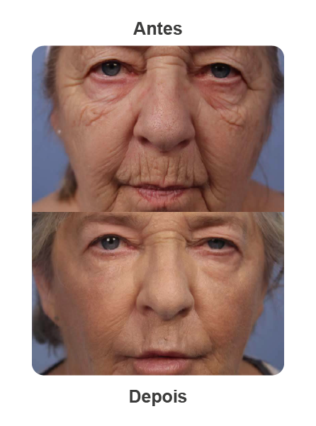 Antes depois de Morpheus