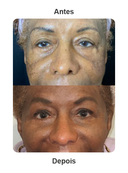 Antes depois de Morpheus