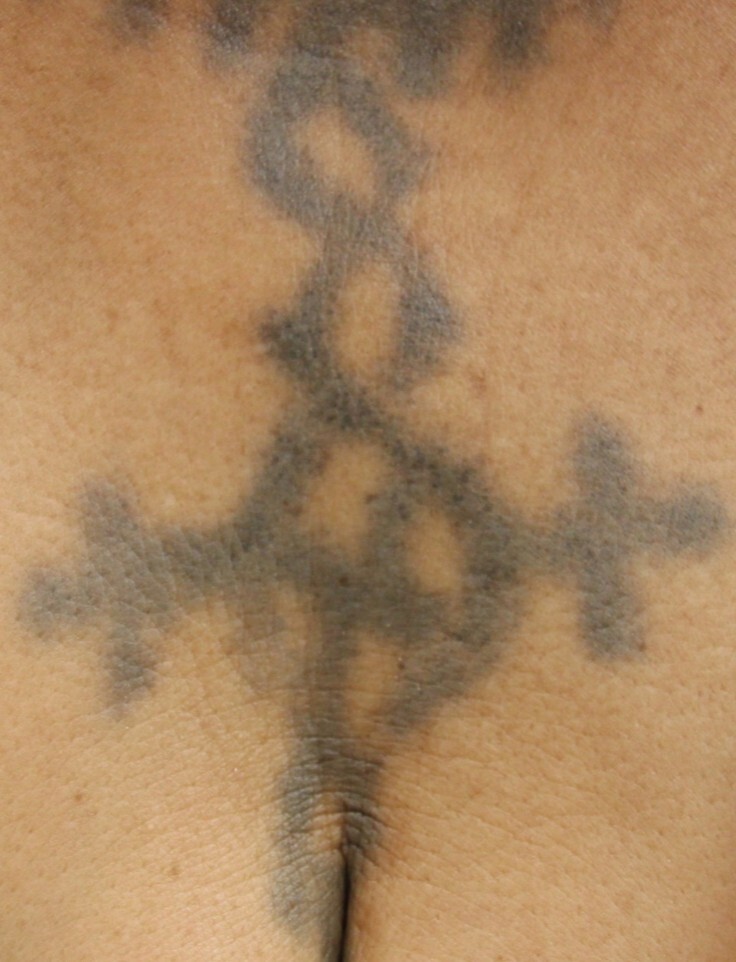 Remoção de tatuagem antes