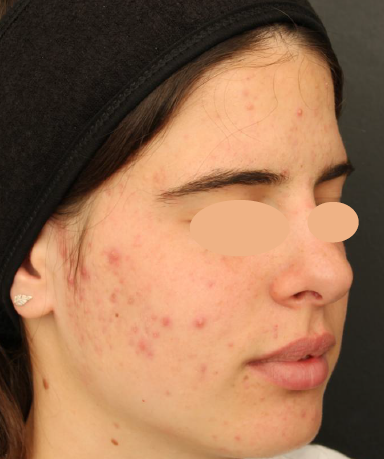 Acne antes