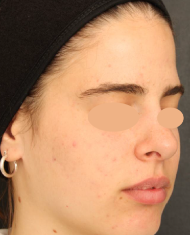 Acne depois