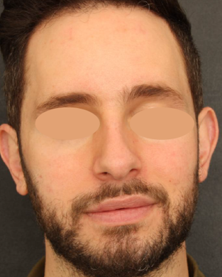 Rosácea depois