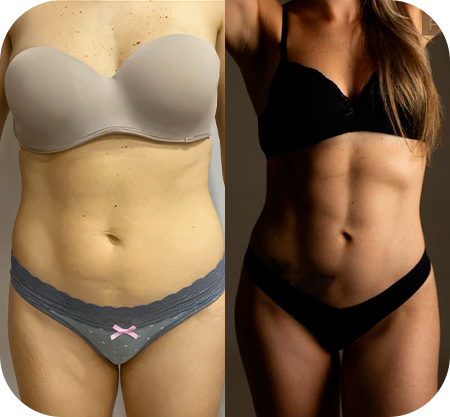 Antes e depois - abdômen