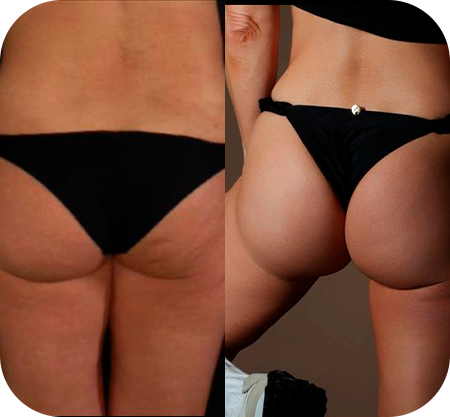Antes e depois - glúteo e coxa