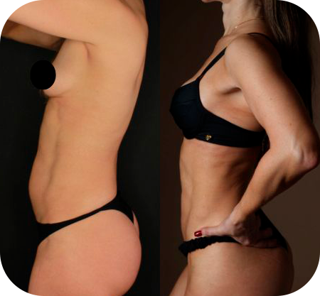 Antes e depois - flanco
