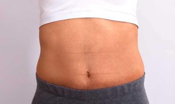 CMSlim_Abdomên_Feminino_Antes_2