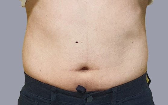 CMSlim_Abdomên_Masculino_Antes_1