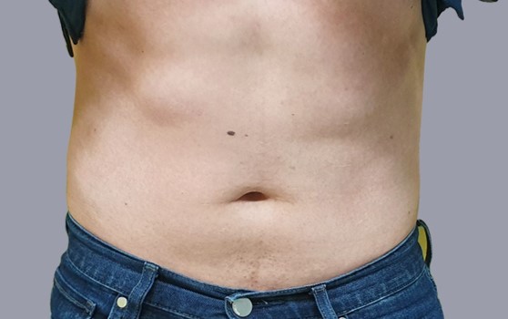 CMSlim_Abdomên_Masculino_Depois_1