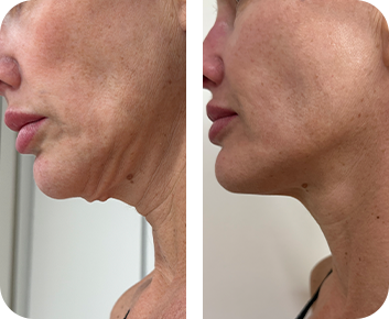Antes e depois - contorno facial