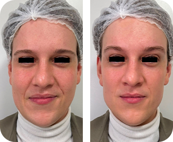 Antes e depois - textura da pele