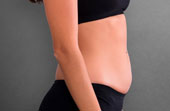 CMSlim_Abdomên_Feminino_Antes