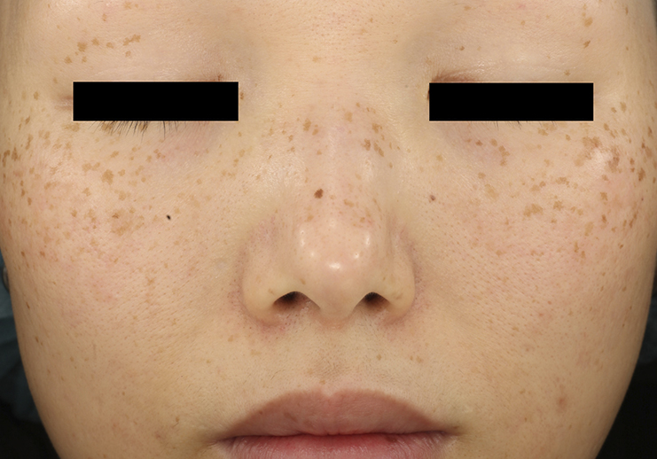 Remoção de manchas de pele com laser PicoWay Antes e depois