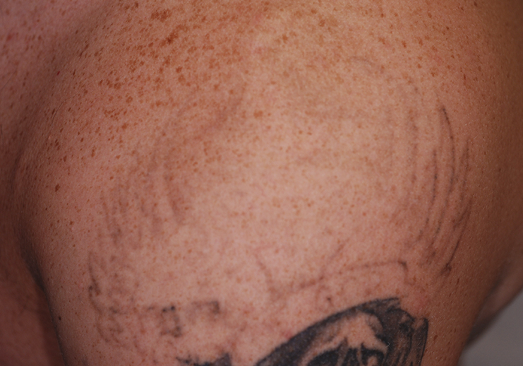 Depois_PicoWay - tratamento para remoção de tatuagem a laser no Brasil